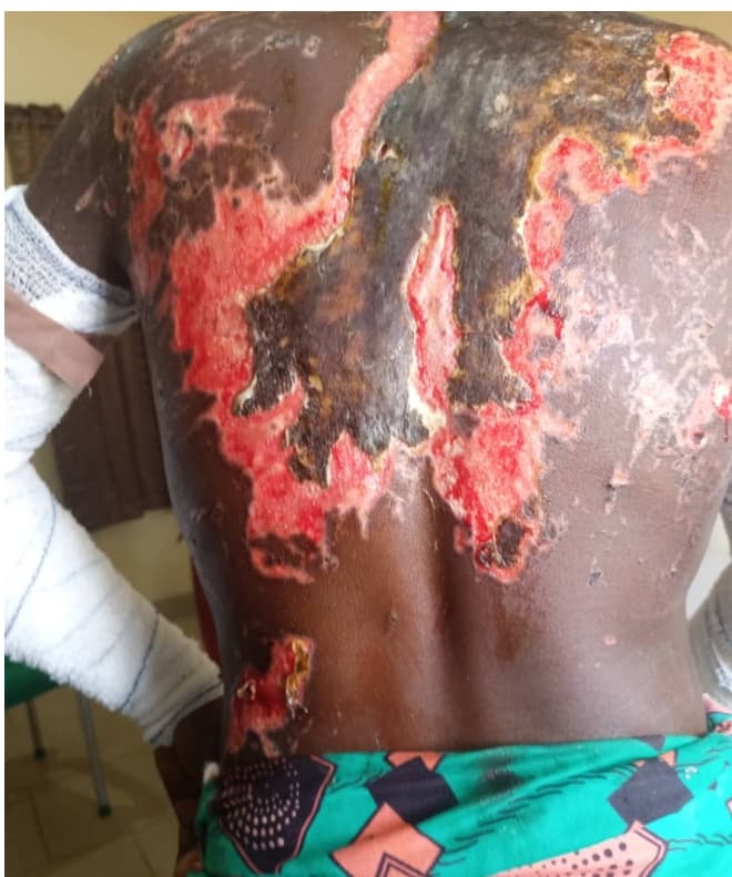 POLICE REOPENS ACID BATH CASE FOR INVESTIGATION IN ADAMAWA‎